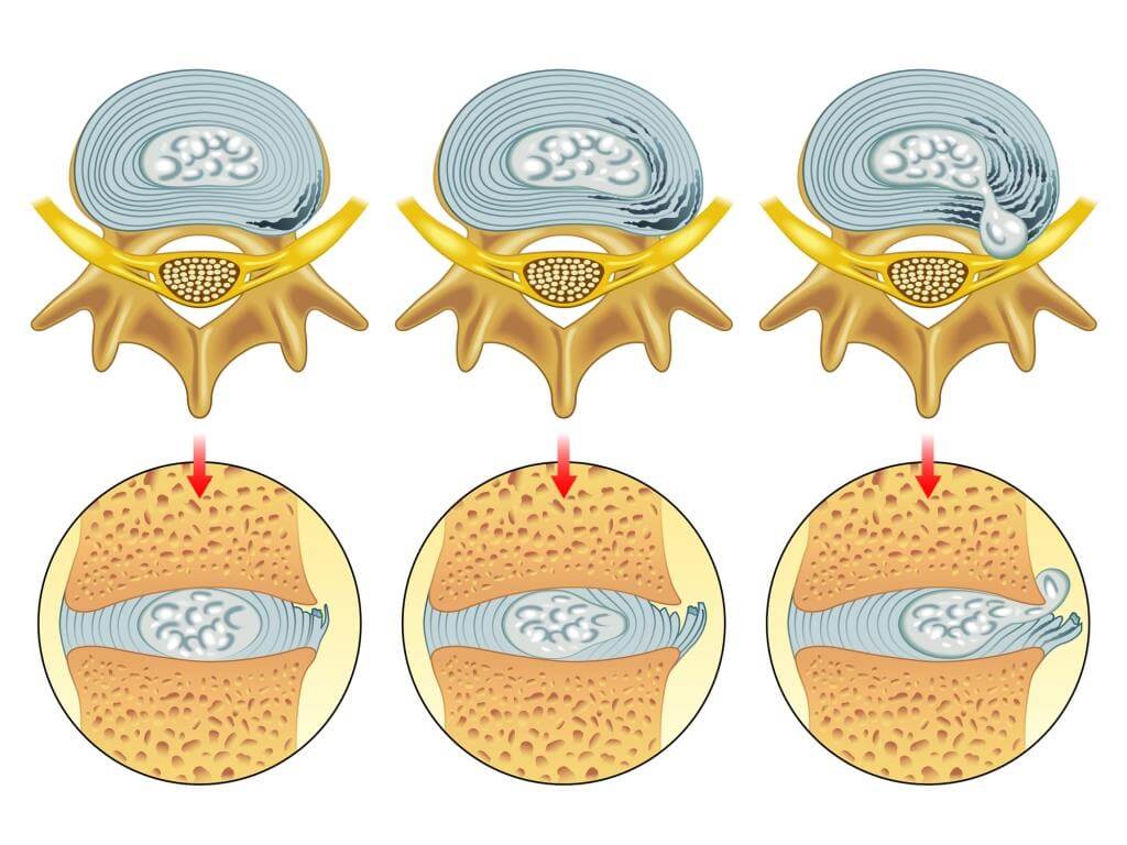 Ilustrace znázorňující tři stadia výhřezu meziobratlové ploténky: normální stav, počínající výhřez a kompletní výhřez, kde je ploténka vytlačená a dotýká se nervu.