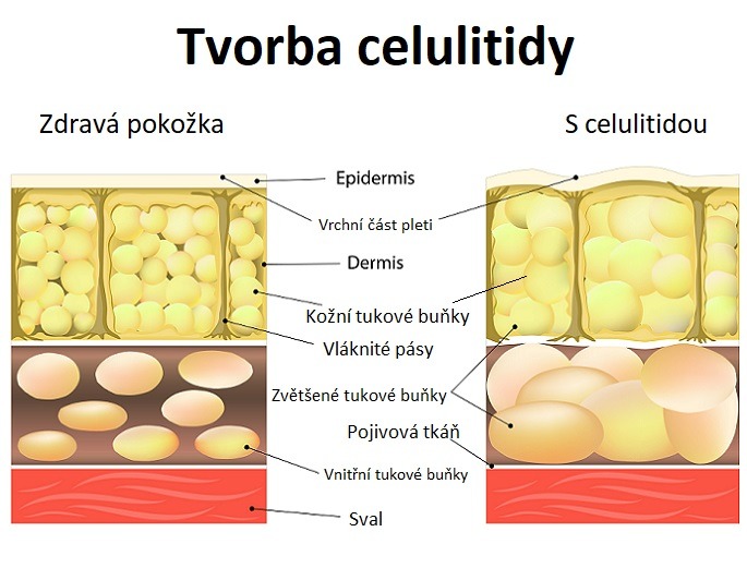 Obrázek vykresluje rozdíl mezi normální pokožkou a pokožkou zasaženou celulitidou.