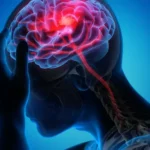 TIA: Příznaky, léčba a prevence mozkové mrtvice