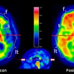 PTSD: Příznaky, léčba a naděje na nový začátek