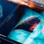 Sybil: AI nástroj předpoví rakovinu plic s 94% přesností