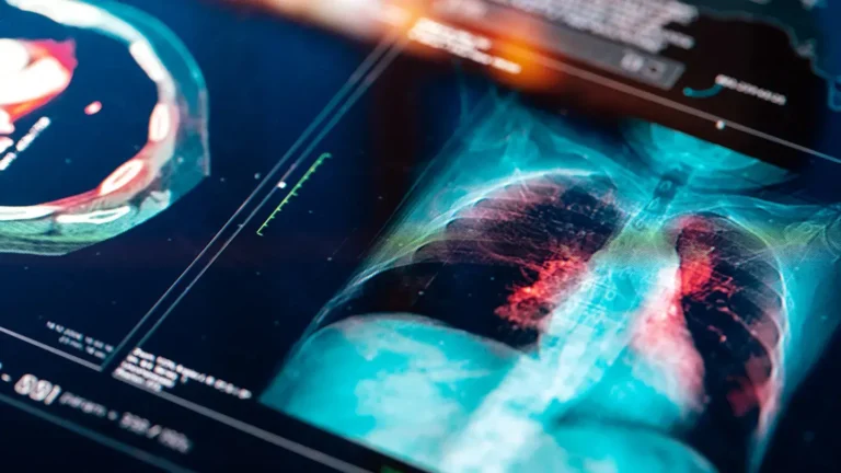 Sybil: AI nástroj předpoví rakovinu plic s 94% přesností