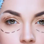 Plastika víček: Zákrok, který zvedne víčka i vaše sebevědomí